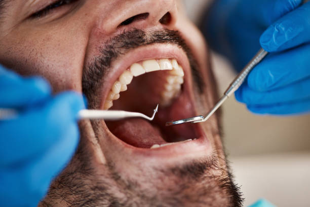 Best Broken or Cracked Tooth Emergency Dentist in Lincoln Village, CA